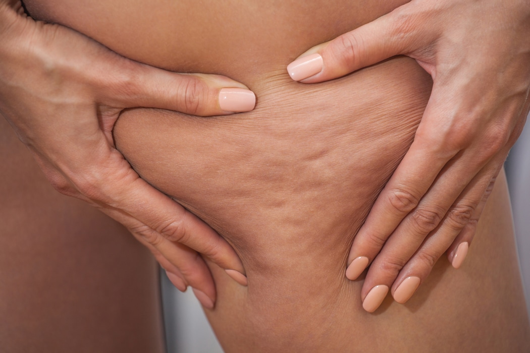 Conseils pour faire disparaitre la cellulite sur les fesses et cuisses