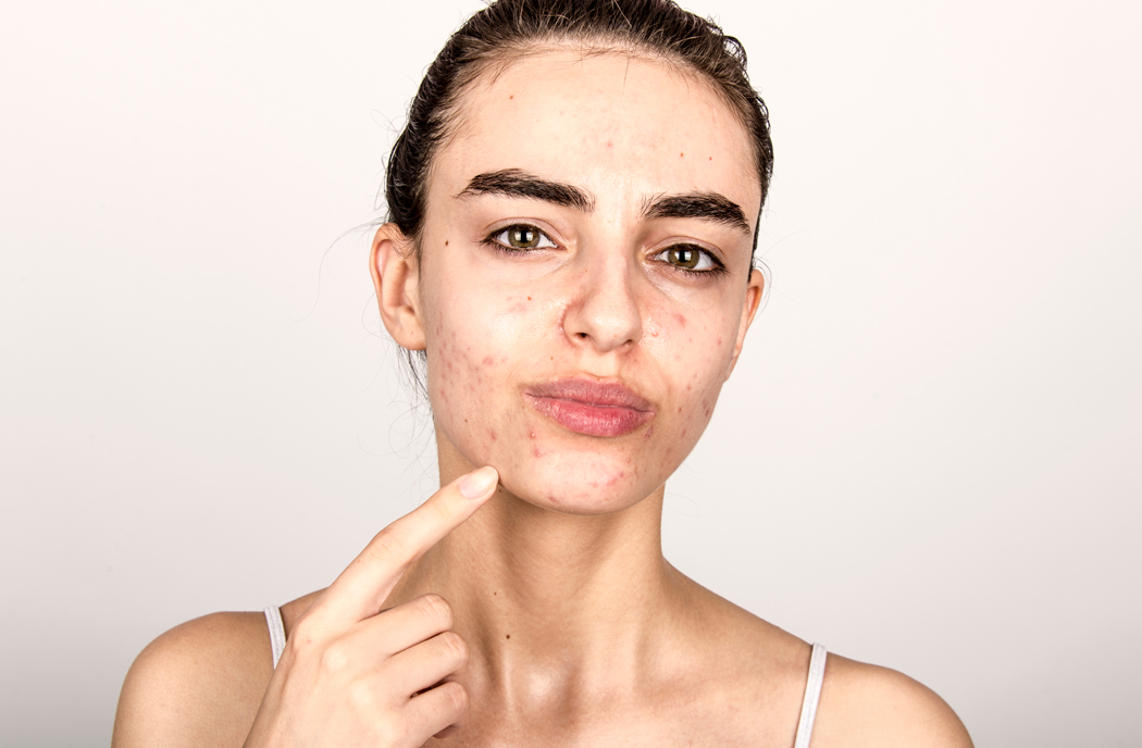 Huile de chanvre contre l'acné