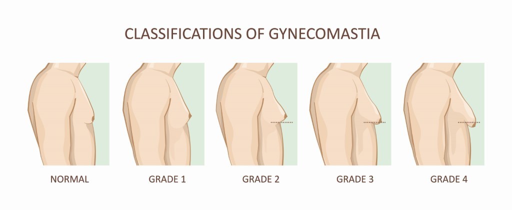 gynecomastie grade homme seins