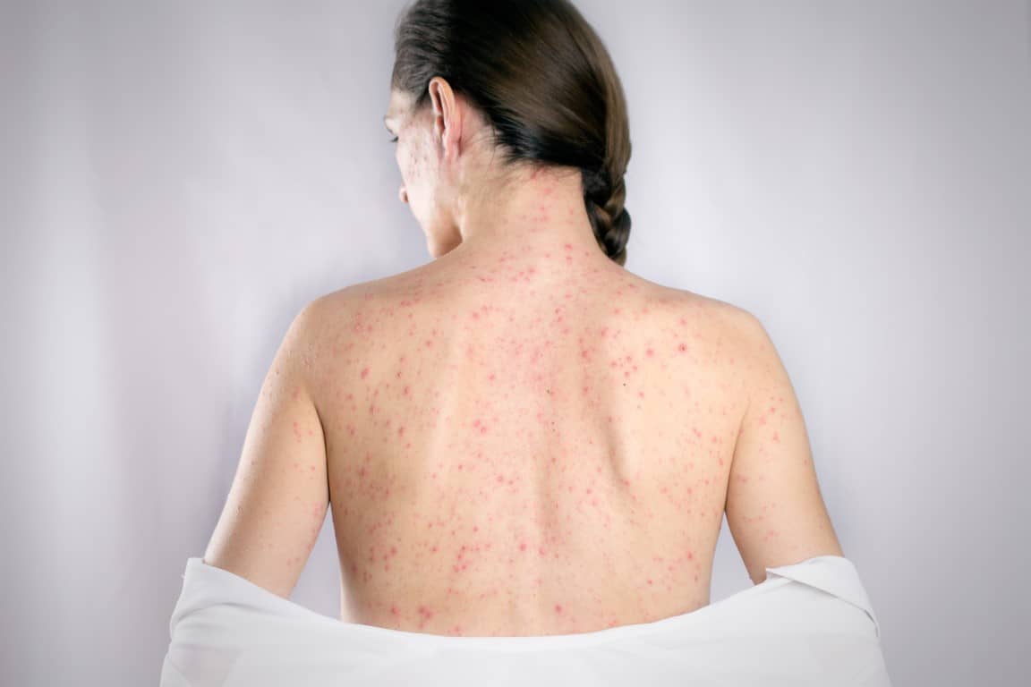 acné du dos important chez une femme
