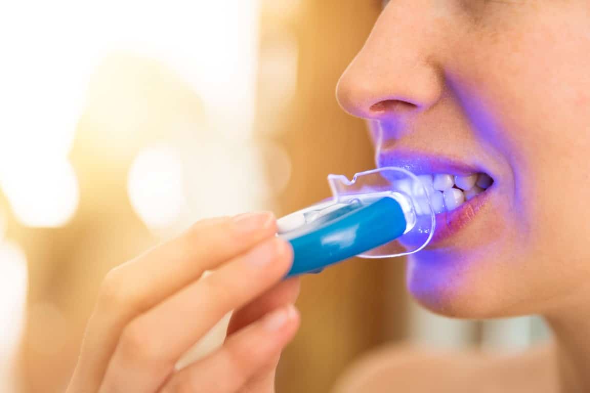 gouttière LED en silicone pour blanchir les dents