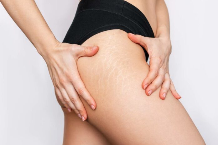 Vergetures sur les cuisses