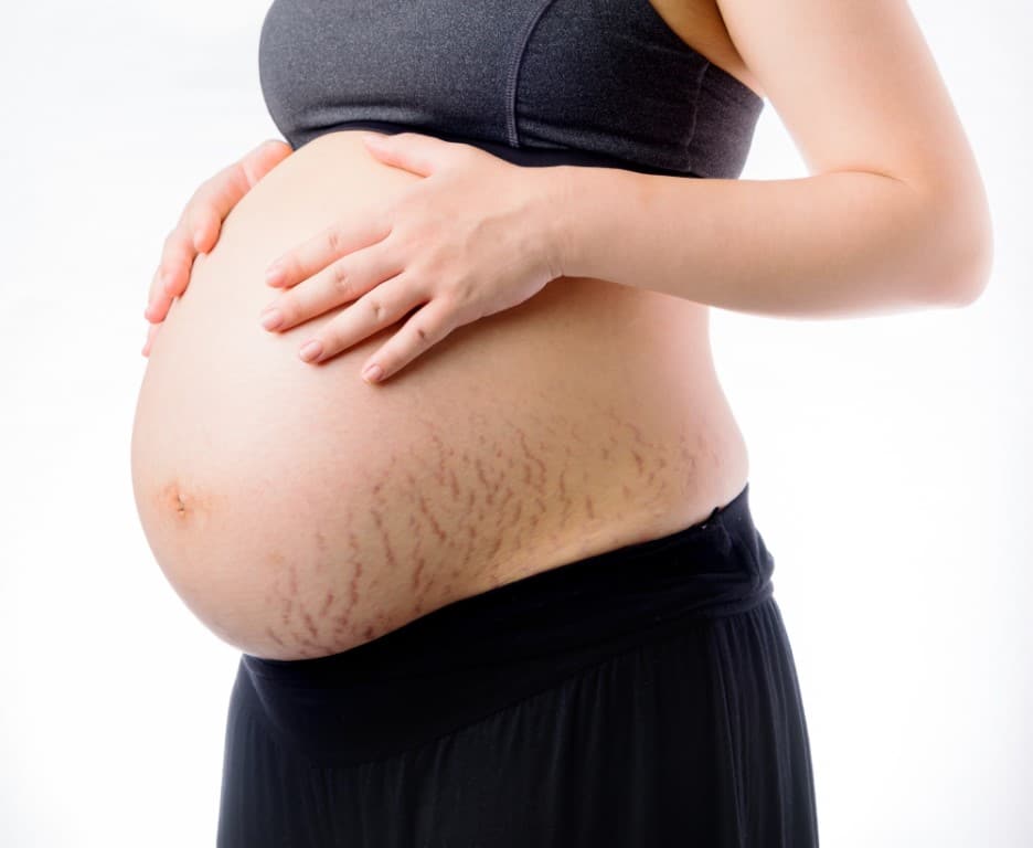 vergetures à cause d'une grossesse